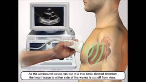 Echocardiogram