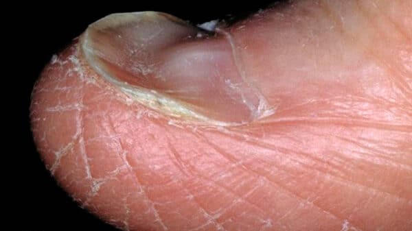 spoon toe nail