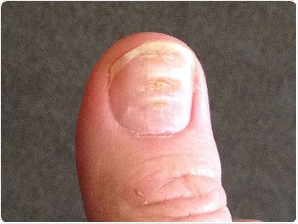 What Do Your Nails Say About Kidney Disease Walkin Lab What Do Your Nails Say About Kidney Disease Walkin Lab