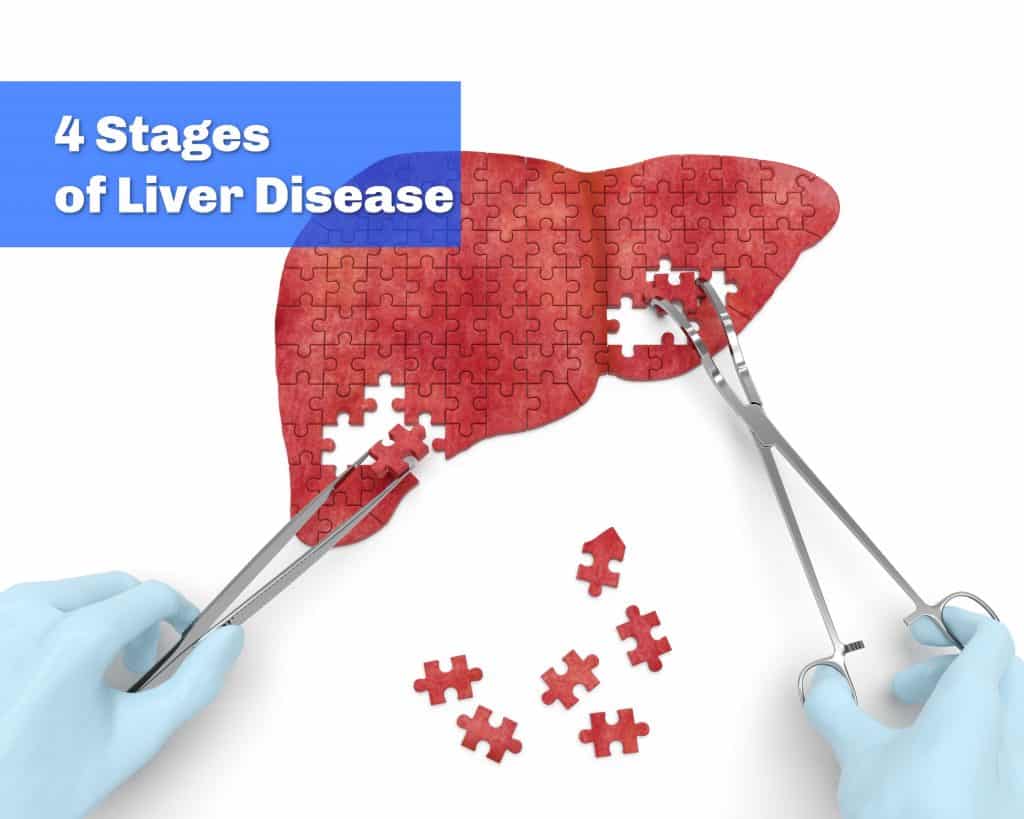 What Are The Four Stages Of Liver Disease?