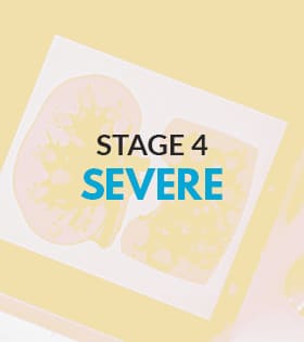 Chronic kidney disease stage 4 - severe