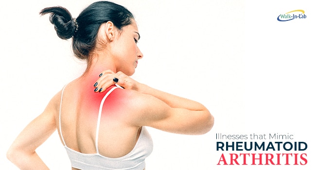 The Connection Between Inflammatory Arthritis and Fibromyalgia