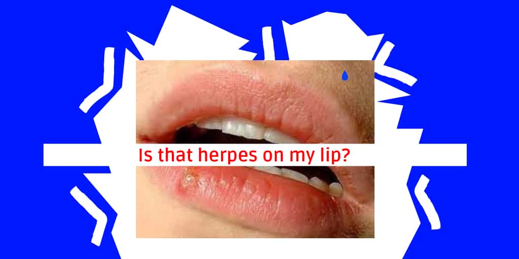 Is that herpes on my lip?