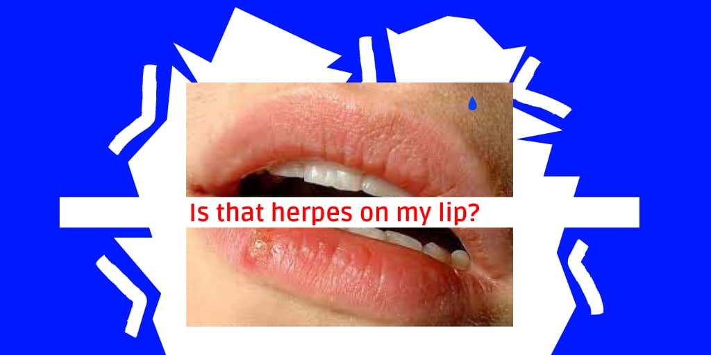 What Percent Of Americans Have Herpes