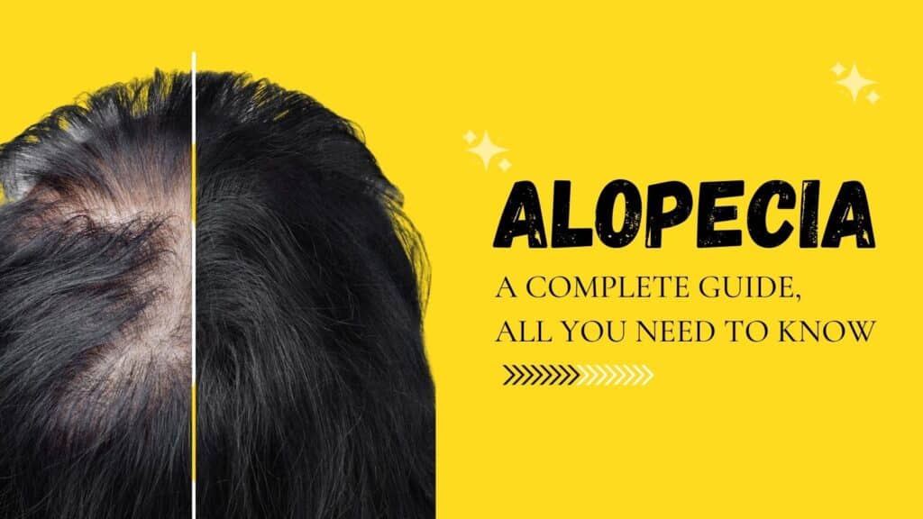 Alopecia: A Complete Guide, All you need to know