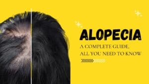 Alopecia: A complete guide, all you need to know