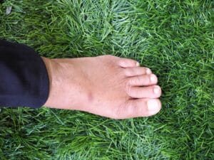 Swollen foot