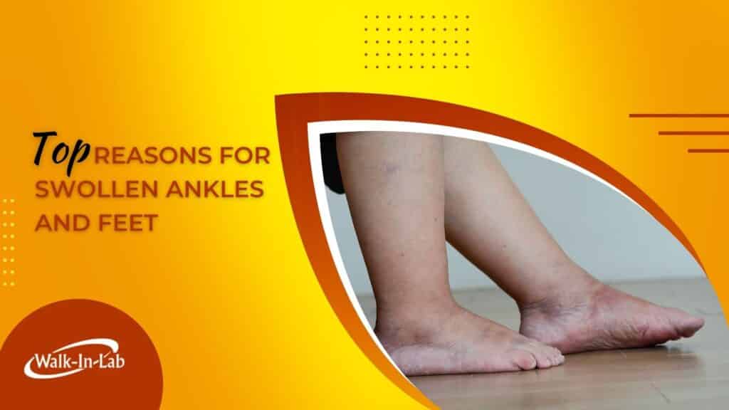 Top Reasons For Swollen Ankles And Feet