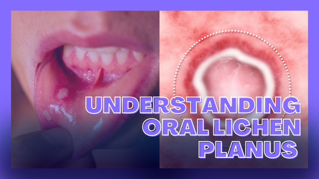 Understanding Oral Lichen Planus: Causes, Symptoms, and Treatment Options