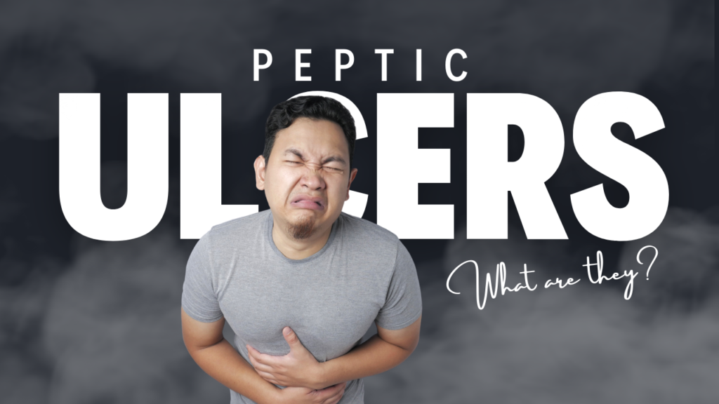 What are Peptic Ulcers?