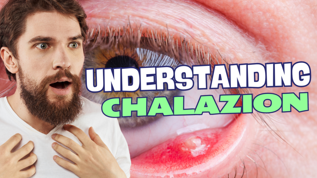 Understanding chalazion