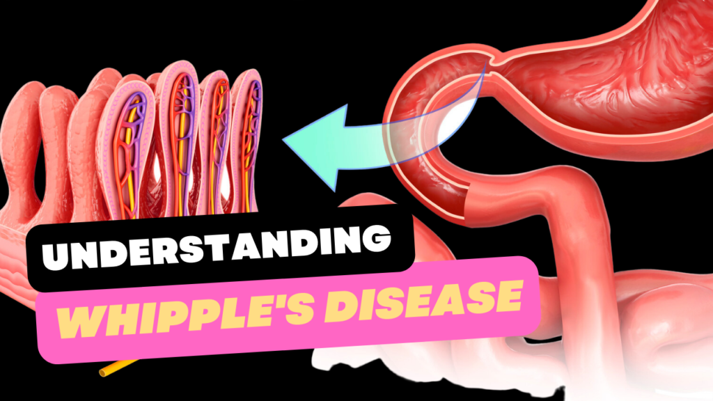 Understanding Whipple’s Disease: A Comprehensive Guide