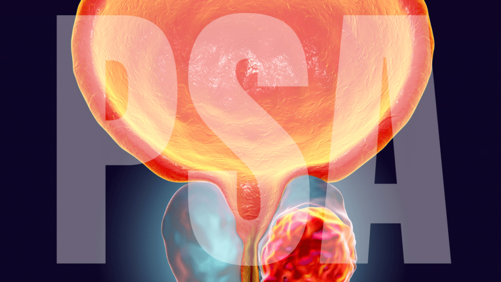 Image: PSA and inagte of prostate. Prostate-specific antigen is a protein produced naturally by cells in the prostate gland, serving as a biological marker that can indicate various prostate conditions. When measured through a simple blood test, PSA levels provide valuable information about prostate health, though the results require careful interpretation within the context of individual risk factors and medical history. The relationship between PSA levels and prostate conditions isn't always straightforward, making professional medical guidance essential for proper evaluation.